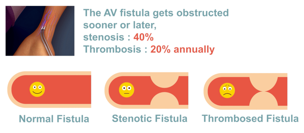 Why & How do we develop our MedDev? 1 Stenosis